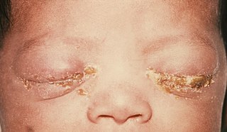 Neonatal conjunctivitis Medical condition