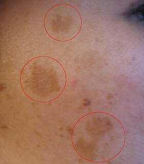 <span class="mw-page-title-main">Melasma</span> Medical condition