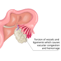 Ovarian torsion