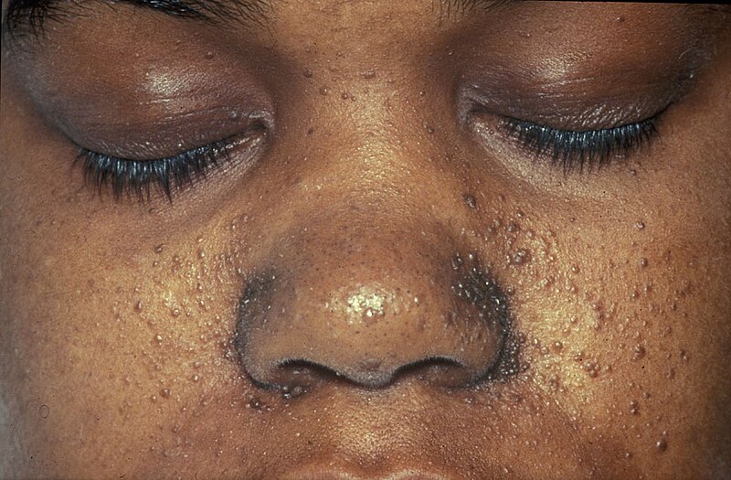 File:Patient with facial angiofibromas caused by tuberous sclerosis.jpg