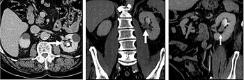 FIGURE 8. Selected images from a CT Urography protocol CT. 8a is an axial CT image from the renal parenchymal phase. There is a mildly enhancing soft tissue mass in the left renal pelvis (arrow) consistent with a transitional cell carcinoma. Figure 8b (coronal reformats) and 8c (left oblique coronal reformats) demonstrate the double bolus technique of CT Urography. These images confirm soft tissue mass (arrows) in the renal pelvis with contrast excretion into the collecting system (arrowheads). Renal parenchymal phase CT of transitional cell carcinoma.jpg