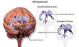 Schizophrenia (Brain).png