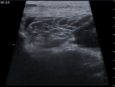 Ultrasound image Cystic Hygroma 20171239531 17F.jpg