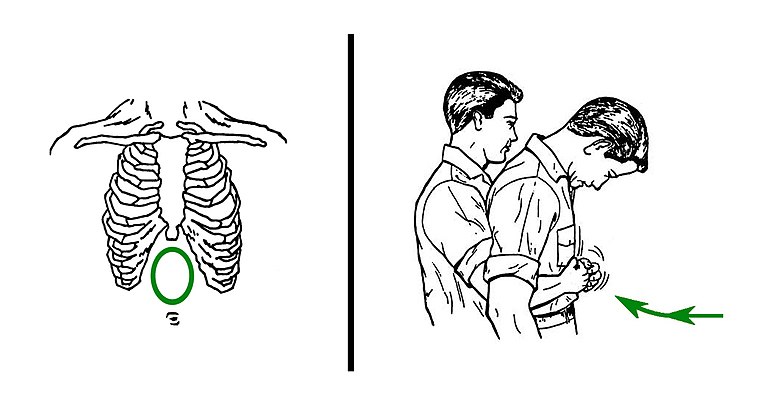 Маневр хеймлиха сколько толчков на живот. Маневр Геймлиха. Прием Геймлиха. Метод Геймлиха. Метод Хеймлиха.