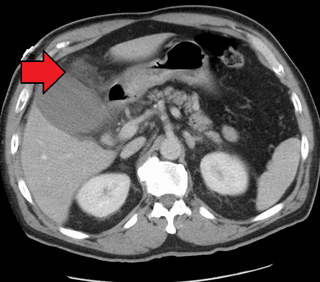 Cholecystitis cholangitis that is characterized by an inflammation that is located in the gallbladder