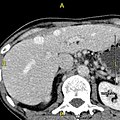 Axial CT image showing anomalous hepatic veins coursing on the subcapsular anterior surface of the liver.[46]