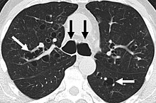 CT scan of the lungs showing findings diagnostic of bronchiectasis. White and black arrows point to dilated bronchi characteristic of the disease. Bronquiectasia.jpeg