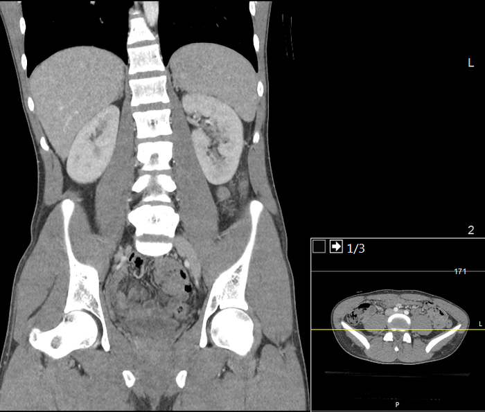 CT of a normal abdomen and pelvis, coronal plane 83.png
