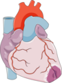 Myocardial infarction - Apical infarct