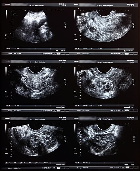 File:Echographie pelvienne, aplio toshiba ssa 700 5 2004 02.JPG