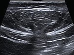 Thumbnail for Epigastric hernia