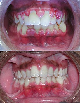 Gengivite grave antes (acima) e após (abaixo) desbridamento cirúrgico meticuloso da ferida dos dentes e tecido gengival adjacente