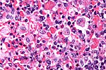 Thumbnail for Hemophagocytic lymphohistiocytosis