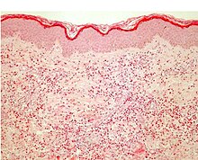 Histology of a skin biopsy from acute phase eosinophilic cellulitis. Note findings of plentiful tissue eosinophils and flame figures at the deeper corium sections (hematoxylin & eosin, original magnification x40). HistEosinCell.jpg