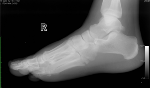 A fracture of the fifth metatarsal of the foot...
