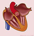 Left atrial enlargement (CardioNetworks ECGpedia).jpg