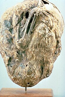 Lithopedion Wikipedia