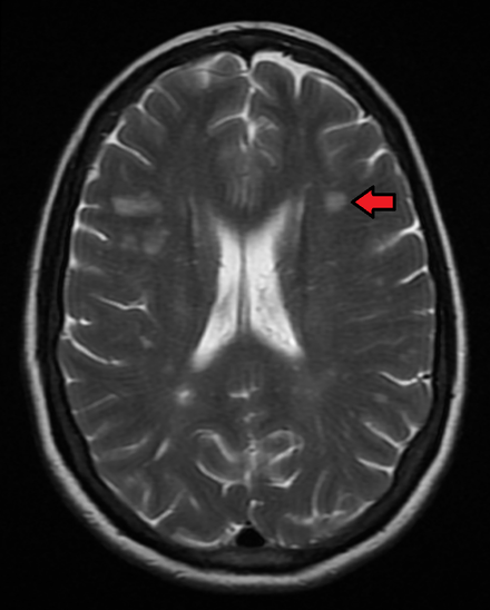 Multiple sclerosis as seen on MRI