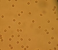 Hematuria: Clasificación, Etiología, Diagnóstico