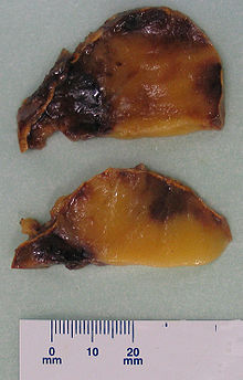 The cut surface of an adrenal myelolipoma shows colour variegation from yellow to red to brown depending on the distribution of fat, blood and myeloid elements Myelolipoma cut surface.jpg