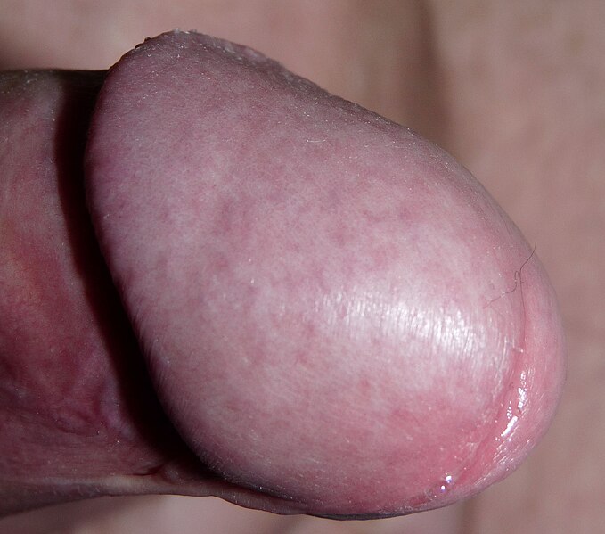 File:Penis Glans.jpg