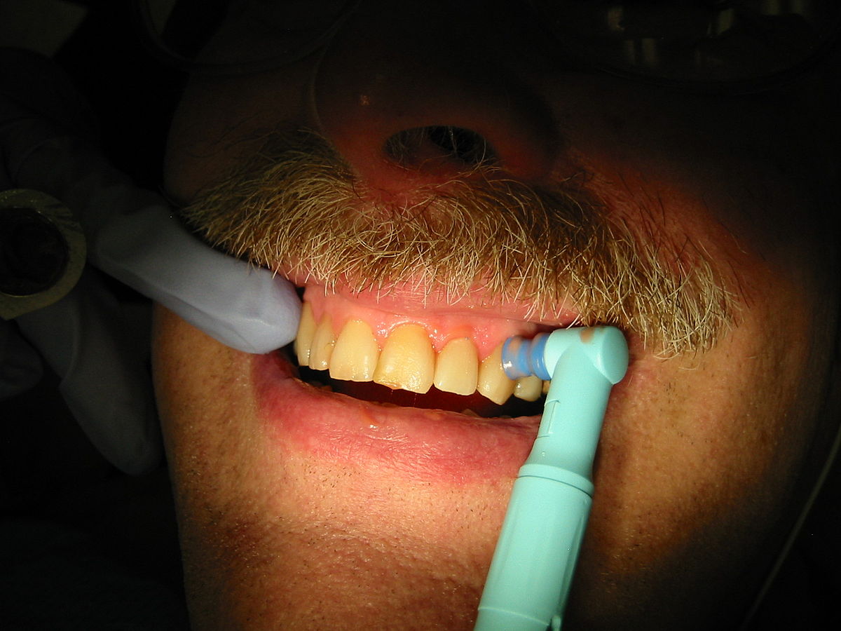 Teeth cleaning - Wikipedia