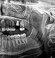 Zahnimplantat Regio 26 unmittelbar nach Implantation und simultanem externem Sinuslift