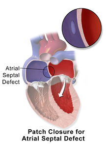 Illustration depicting surgical patch closure of ASD Blausen 0070 AtrialSeptalDefect PatchClosure.png