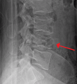 ภาพเอ็กซเรย์ - burst fracture ของกระดูกสันหลังระดับเอว L4 มุมมองด้านข้าง