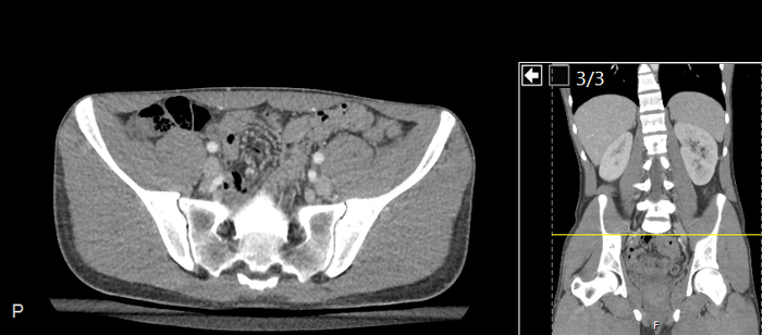 CT of a normal abdomen and pelvis, axial plane 201.png