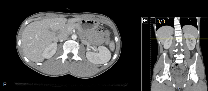 CT of a normal abdomen and pelvis, axial plane 94.png