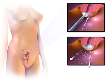 Cervical cryotherapy Cervical Cryotherapy.png