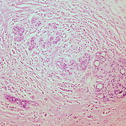 Classic Invasive Lobular Carcinoma of the Breast (6959258373).jpg