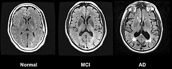 Drei Magnetresonanztomographie-Schnittbilder. Von links nach rechts mit Normal, MCI und AD beschriftet. Das linke Bild zeigt keine alzheimer-typischen Veränderungen, das mittlere mittelgradige Veränderungen, das rechte starke Veränderungen.