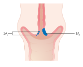 Diagram showing stage 1A cervical cancer CRUK 200.svg