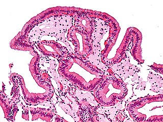 Foam cell fat-laden M2 macrophages seen in atherosclerosis