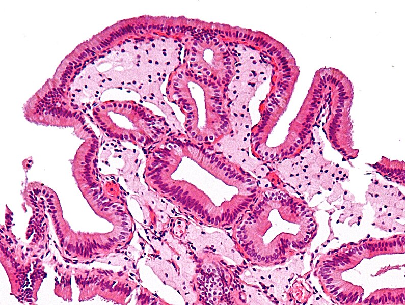 File:Gallbladder cholesterolosis intermed mag cropped.jpg