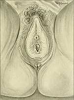 Thumbnail for Kraurosis vulvae