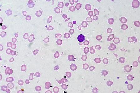ไฟล์:Iron-deficiency Anemia, Peripheral Blood Smear (4422704616).jpg