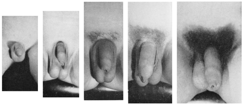 File:Male genitalia five Tanner stages.png