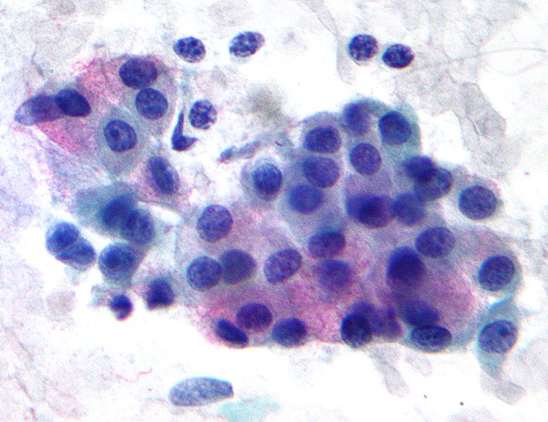 File:Mucoepidermoid carcinoma 2 - very high mag.jpg