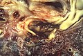 Mycotic pulmonary artery aneurysm, ruptured (4860663580).jpg