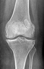 Thumbnail for File:Patella bipartita Roentgen ap.jpg