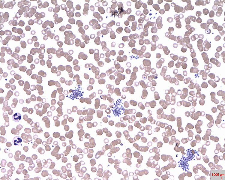 File:Plasmodium falciparum in a patient presenting with pyrexia and headache.jpg