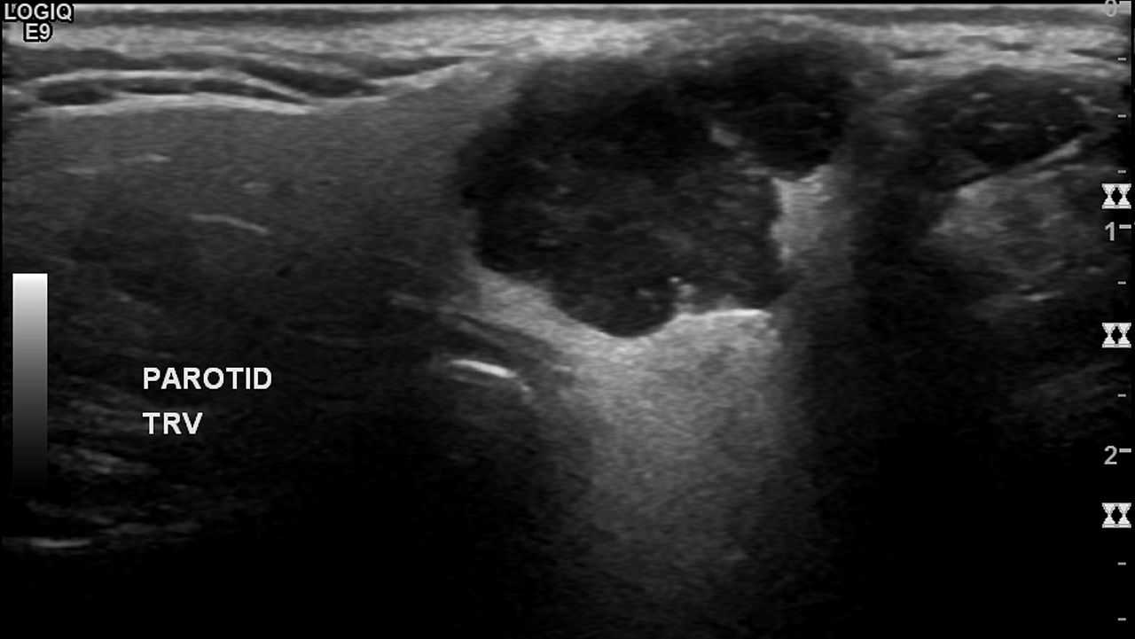 pleomorphic adenoma ultrasound