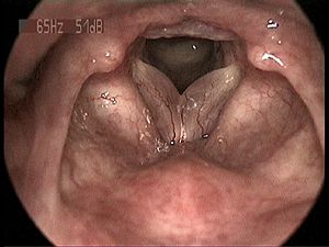 Acid reflux and throat nodules