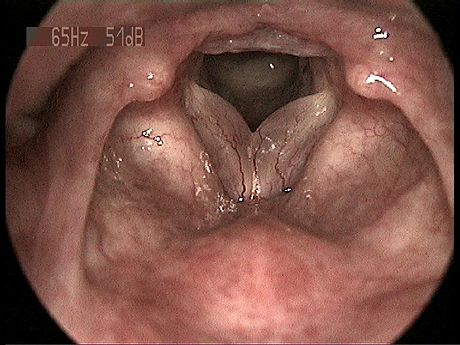 Reinke's edema