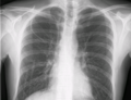 Chest x-ray with catheter in the right subclavian vein