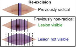 Tissue selection from skin re-excisions.png