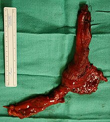 Image of a surgically removed esophagus due to late-stage Achalasia